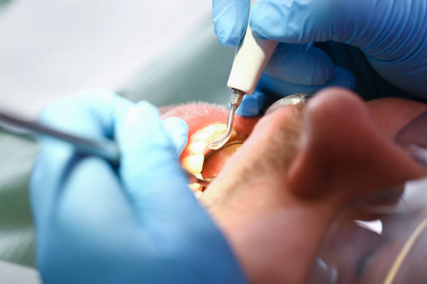 Best Root Canal Emergency Dentist  in Burns Flat, OK
