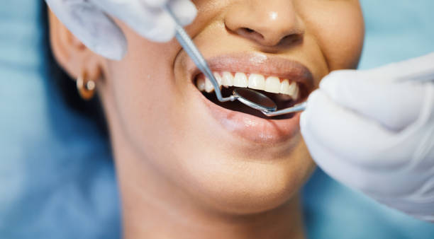 Best Chipped Tooth Repair Near Me  in Burns Flat, OK